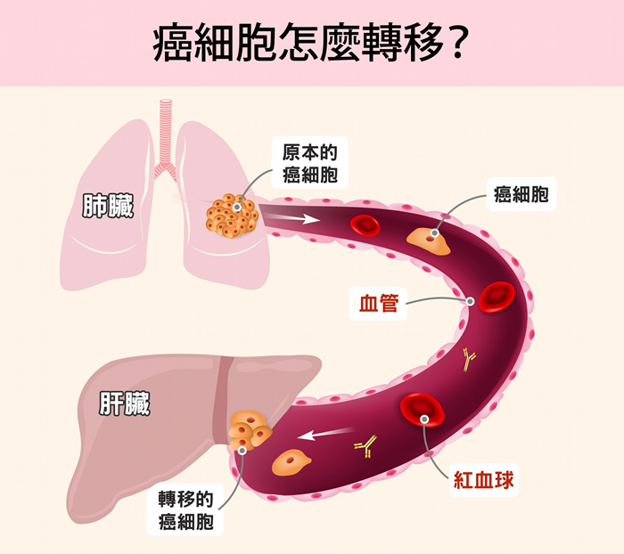 癌症（Cancer) 或称作恶性肿瘤（Malignant tumor），源自身体某个部位有细胞不正常的增生。 肿瘤形成之后，可能从原本部位向周围组织扩张，藉由淋