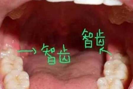 智齿应不应该拔掉,三张图片告诉你答案